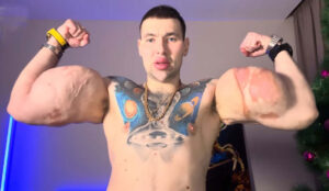 The craze of making muscles by injecting 3-3 liters of vaseline in both hands